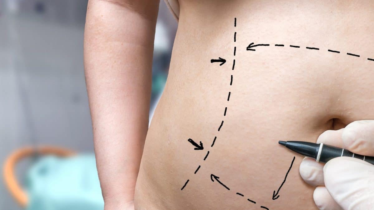 Weight Loss Surgery